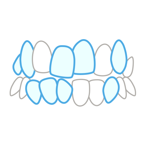 叢生（乱ぐい歯）