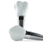 インプラント治療