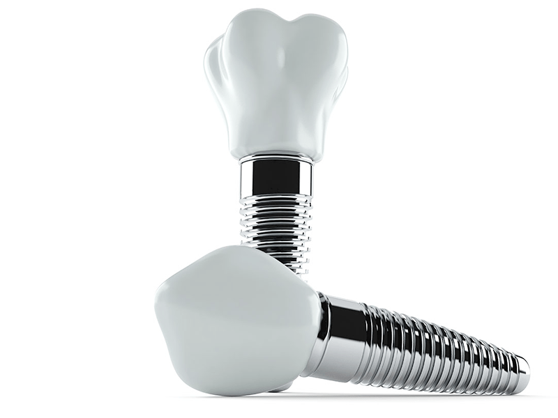 インプラント治療