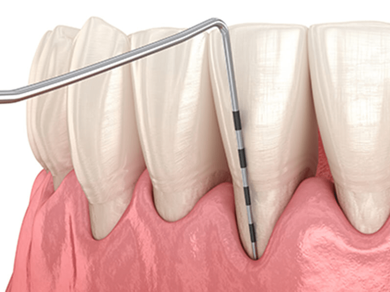 プロービング検査