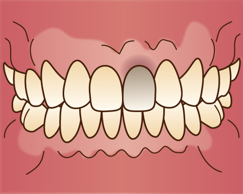 神経を抜いて変色してしまった歯