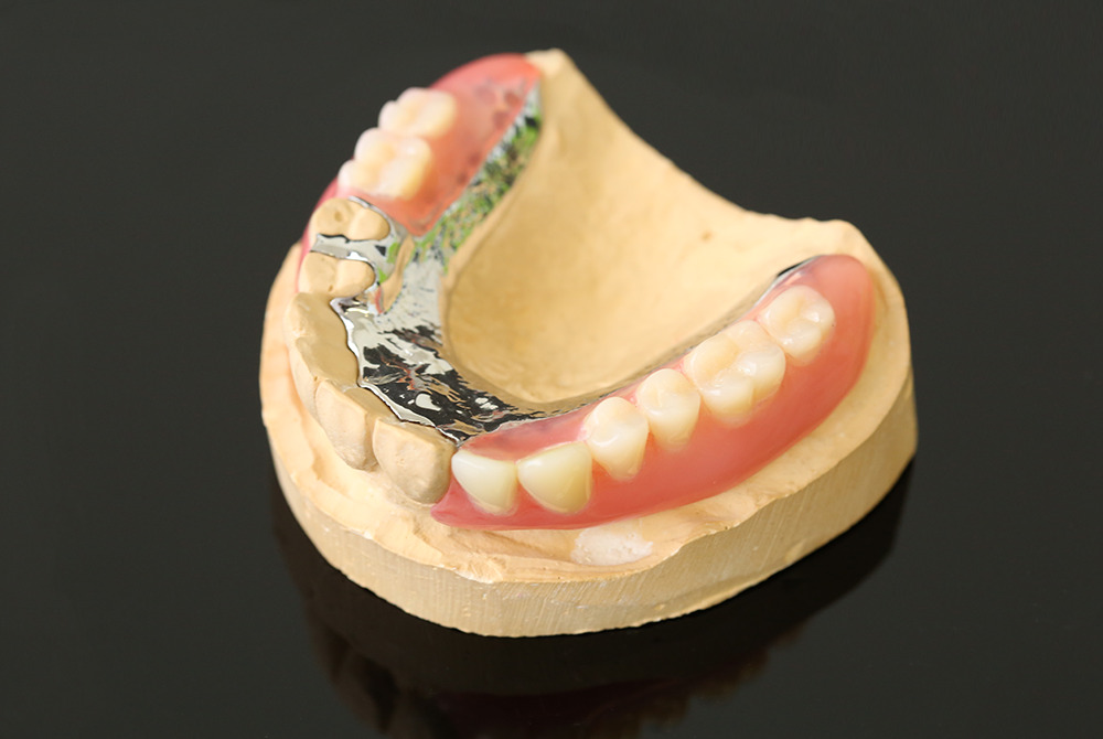 部分入れ歯（部分義歯）