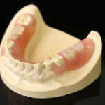 ノンクラスプデンチャー