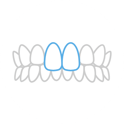 出っ歯（上顎前突）