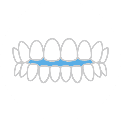 前歯が閉じない（開咬※注2）