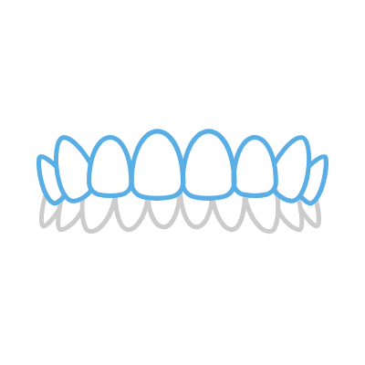 噛み合わせが深い（過蓋咬合）