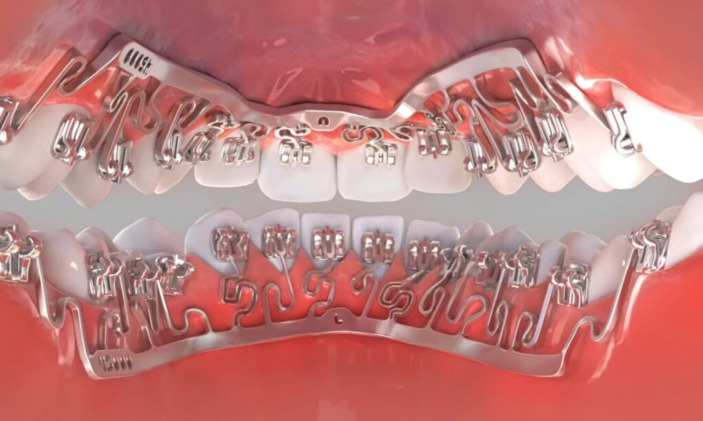 裏側矯正ブラーバ（Brava）