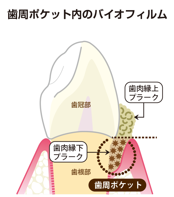 歯周ポケット内のバイオフィルム