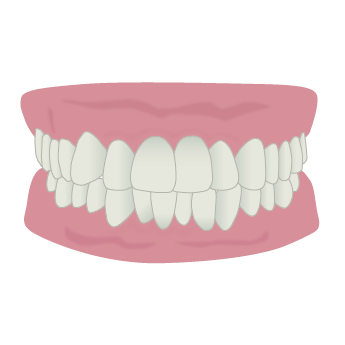 ガタガタした歯並び（叢生）