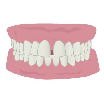 すきっ歯（空隙歯列弓）