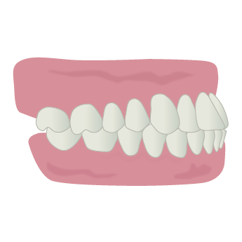 浅い噛み合わせ