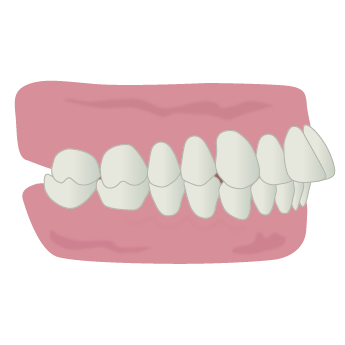 出っ歯（上顎前突）