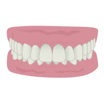 噛み合わせが深い