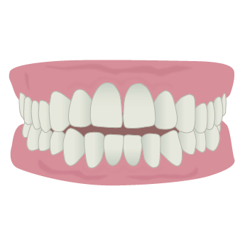 前歯が閉じない（開咬）