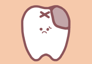 むし歯になってしまった歯